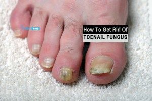 Nail Fungus Cream Newest Treatment For Fingernail Fungus 2017 Toenail Fungus Remedies Nail Fungus Cure Nail Fungus Treatment Toenails