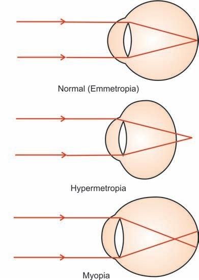 Reflection In The Eye Definition Myopia Emmetropia Ametropia