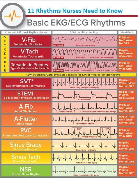 EKG ECG Cheat Sheet 11 Basic Rhythms Nurses Need To Know - basic p&l template EKG ECG Cheat Sheet 11 Basic Rhythms Nurses Need To Know - basic p&l template