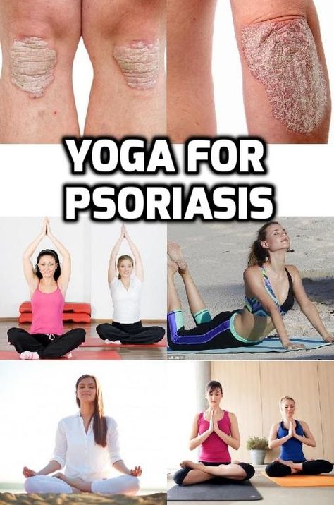 can psoriasis be cured by yoga)