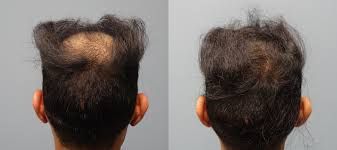 Neograft Hair Transplant Procedure Hair Transplant Neograft Neograft Hair Transplant Procedure Hair Transplant Neograft