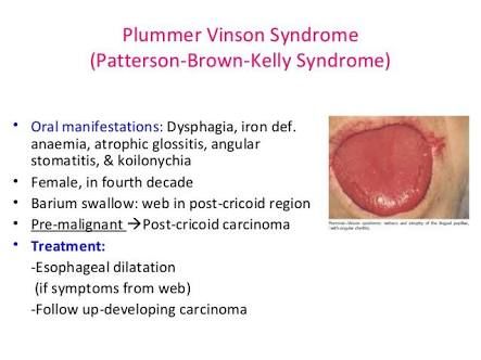 plummer vinson syndrome