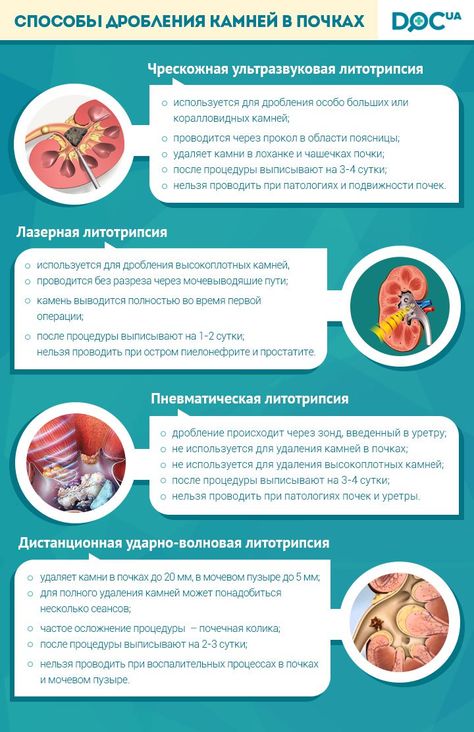 после дробления камня диета после дробления камня диета