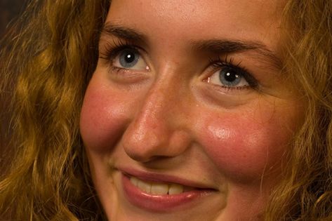 dieta y acne blog post dermatologology dieta y acne blog post dermatologology