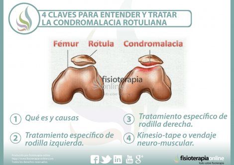 4 Claves Para Entender Y Tratar La Condromalacia Rotuliana Condromalacia Rotuliana Condromalacia Vendaje Neuromuscular