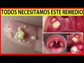 18 Ideas De Amigdalitis Amigdalitis Remedios Para La Amigdalitis Remedios Caseros