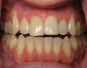 أسباب انحسار اللثة والوقاية من تآكلها وطرق العلاج Receding Gums Gum Disease Treatment Gum Disease