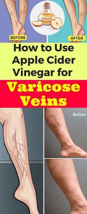 Can You Get Rid Of Varicose Veins Reddit 5 Charming Clever Ideas How To Treat Internal Hemorrhoids Cream Does Apple Cider Vinegar Heal H Hemorrhoid Remedies Cure For Hemorrhoids Bleeding Hemorrhoids