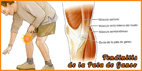 tratamiento para tendon pata de ganso