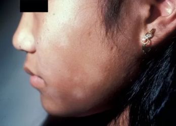 What do white spots on body mean What do white spots on body mean