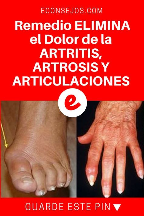 gotas+naturales+para+la+artrosis