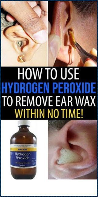 Can You Use Hydrogen Peroxide To Clean Ears Hydrogen Peroxide Can Clear Ear Infections And Remove Ear Wax Here S How To Use It Ear Infection Remedy Ear Infection Ear Wax