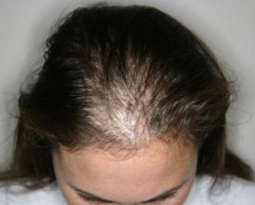 Haarausfall Hier Gibt Es Hilfe Fur Alle Frauen Aktiv Haarwuchs Fordern Mit Frummi Das Haargummi Haarausfall Haarwuchs Haarverlust