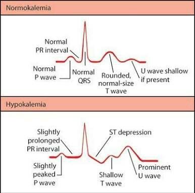 T Waves In Ischemia Hyperacute Inverted Negative Wellen S Sign De Winter S Sign Wells Winter