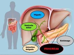 es la diabetes tipo 1 relacionada con el cáncer de páncreas