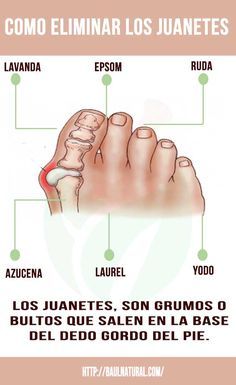 Juanetes causas emocionales Juanetes causas emocionales