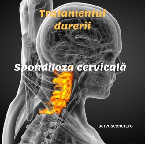 Spondiloza cervicala: cauze, simptome si cum tratam durerea