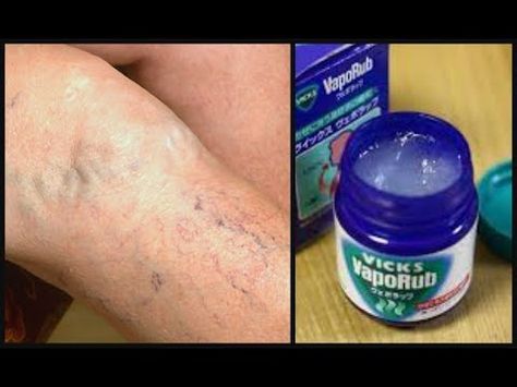 Pin On Varices