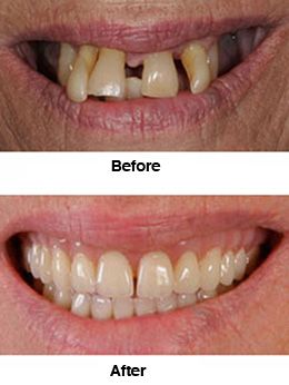 Dental Technician Brisbane Dental Mechanics Brisbaneㅣdenture Clinic Dental Cosmetics Dental Dental Health Care