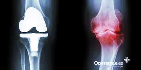14 Ideas De Protesis Rodilla Rodillas Cirugía De Rodilla Ligamentos De La Rodilla