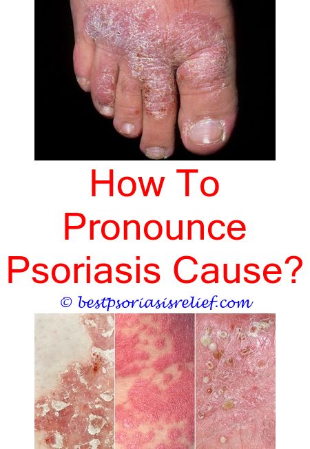 palmoplantar pustulosis behandling palmoplantar pustulosis behandling