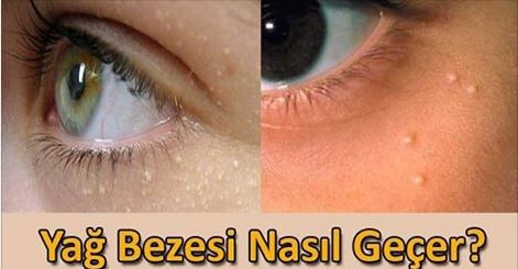 Yag Bezesi Nasil Gecer Moda Trend Yag Saglik Bakim Saglik Ve Fitness Yag Bezesi Nasil Gecer Moda Trend Yag Saglik Bakim Saglik Ve Fitness