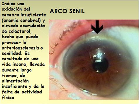 tratamiento de la diabetes con halo senil