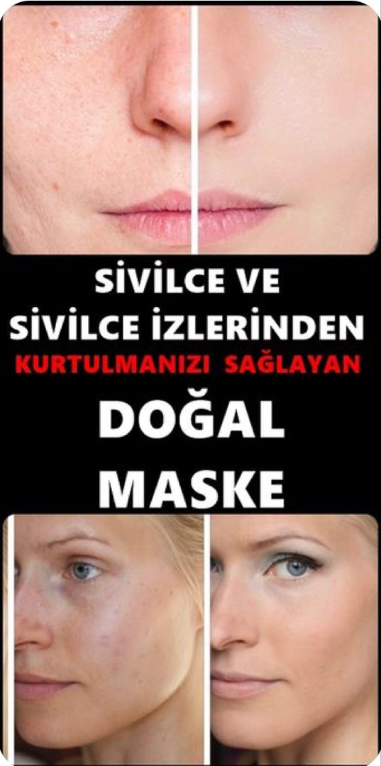 Cilt Bakimi Sivilce Izi Cilt Bakimi Organik Cilt Bakimi Cilt Bakimi Sivilce Izi Cilt Bakimi Organik Cilt Bakimi