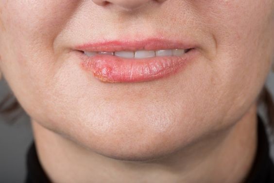 Causas de las herpes labiales