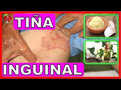 que sirve para la tiña inguinal