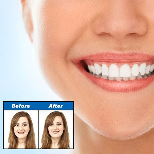 How To Fix A Crooked Smile Naturally