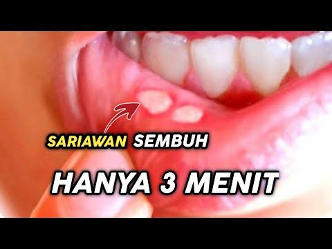 Paling Ampuh Obat Sariawan Paling Ampuh Cara Menyembuhkan Sariawan Secara Alami Obat Sariawan Youtube