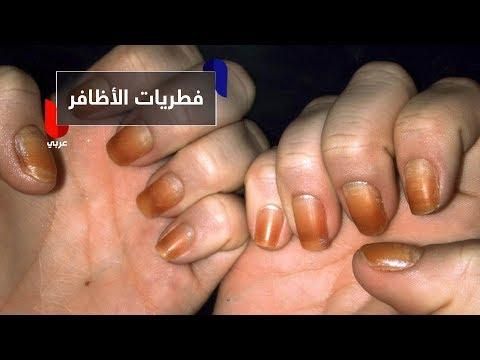 كيف يمكن معالجة فطريات الأظافر والوقاية منها Convenience Store Products Convenience Store