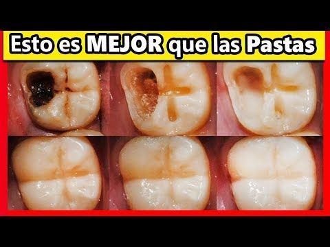 como se quita el halitosis