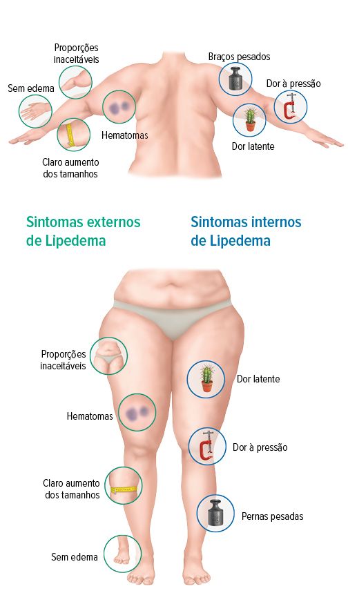 Scleroterapia varicelor