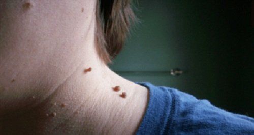cum se ameliorează mâncărimea verucilor genitale sintomi papilloma virus femminile