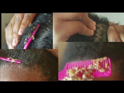 eating psoriasis flakes egy kis vörös pelyhes folt a bőrön