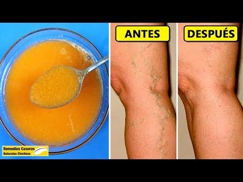 inflamaie acuta în varicoza
