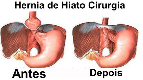 cirurgia de estomago hernia de hiato cirurgia de estomago hernia de hiato