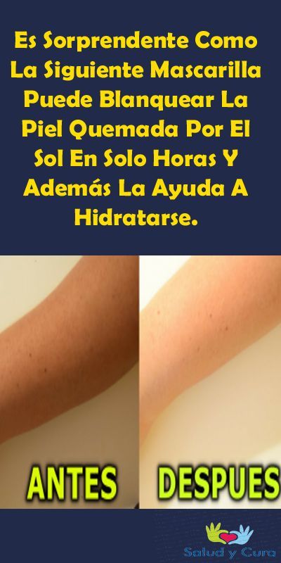 Es Sorprendente Como La Siguiente Mascarilla Puede Blanquear La Piel Quemada Por El Sol En Solo Horas Y Además La Ayuda Skin Treatments Diy Skin Care Skin Care