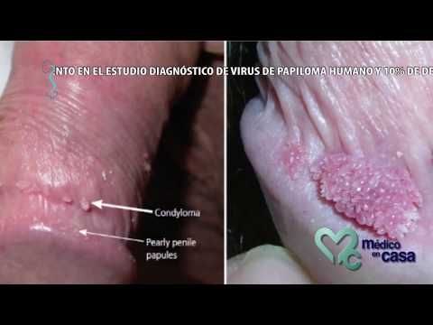 papillomavirus infection squamous cell