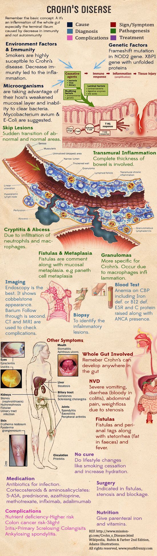 Crohn S Disease Crohns Disease Medical Education Medical