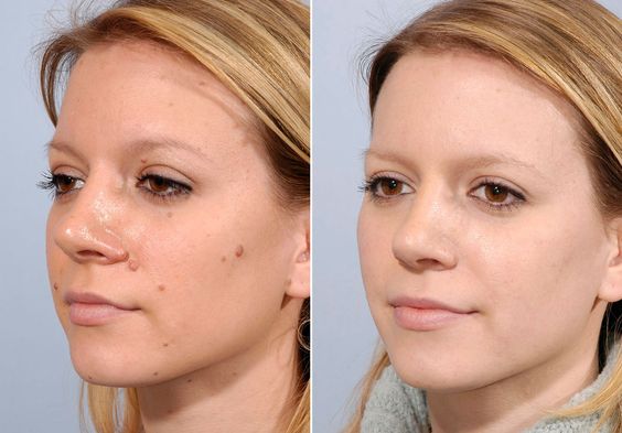 Sign In Mole Removal Skin Tag Removal Skin Tag