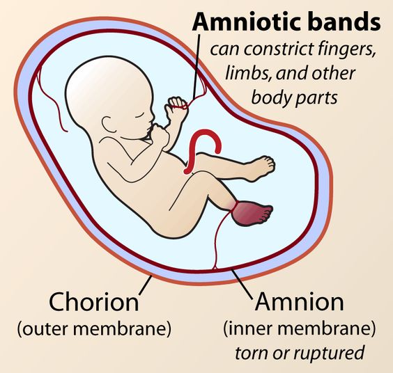 Amniotic Band Syndrome