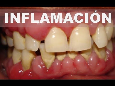 Quitar inflamacion de encias