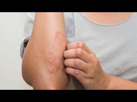 Cura Las Alergias De La Piel Con Estos 3 Remedios Caseros Youtube Skin Allergies Eczema Treatment Types Of Psoriasis