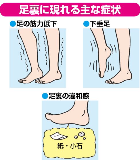手術でも改善しない足裏のしびれ 脱力感が引いた人も 専門医推奨 足の薬指引っぱり カラダネ 手術 太ももの外側 改善 手術でも改善しない足裏のしびれ 脱力感が引いた人も 専門医推奨 足の薬指引っぱり カラダネ 手術 太ももの外側 改善