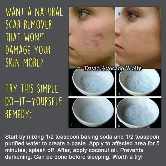 Acne No More Acne Acne Free Skin Acne Problem