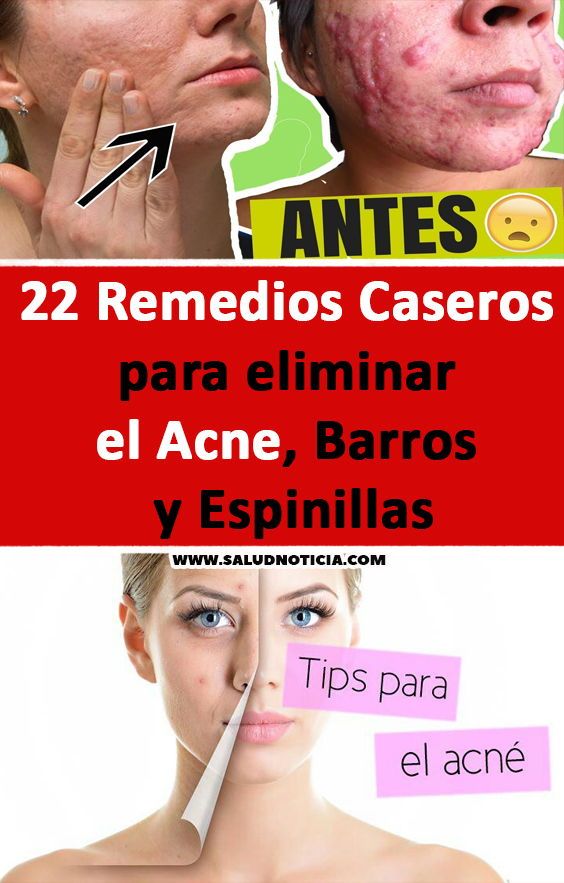 Para espinillas caseros remedios eliminar las