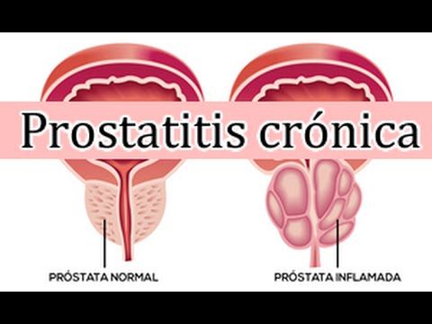 Terapia hormonală Cancer de prostata tratamiento hormonal